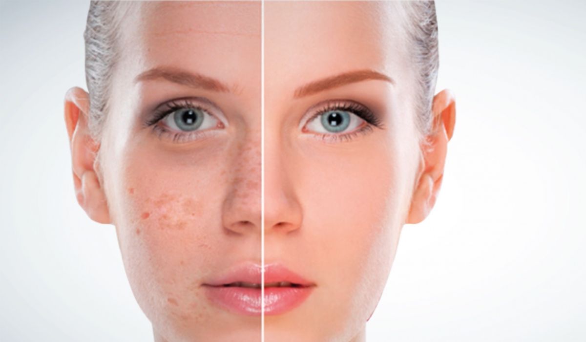 Hyperpigmentation